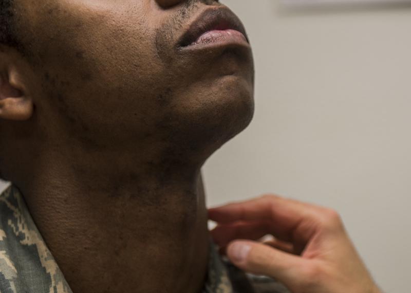 A Skin Condition Makes It Hard For Some Black Men To Shave — And Get Ahead In The Military - Vimarsana News