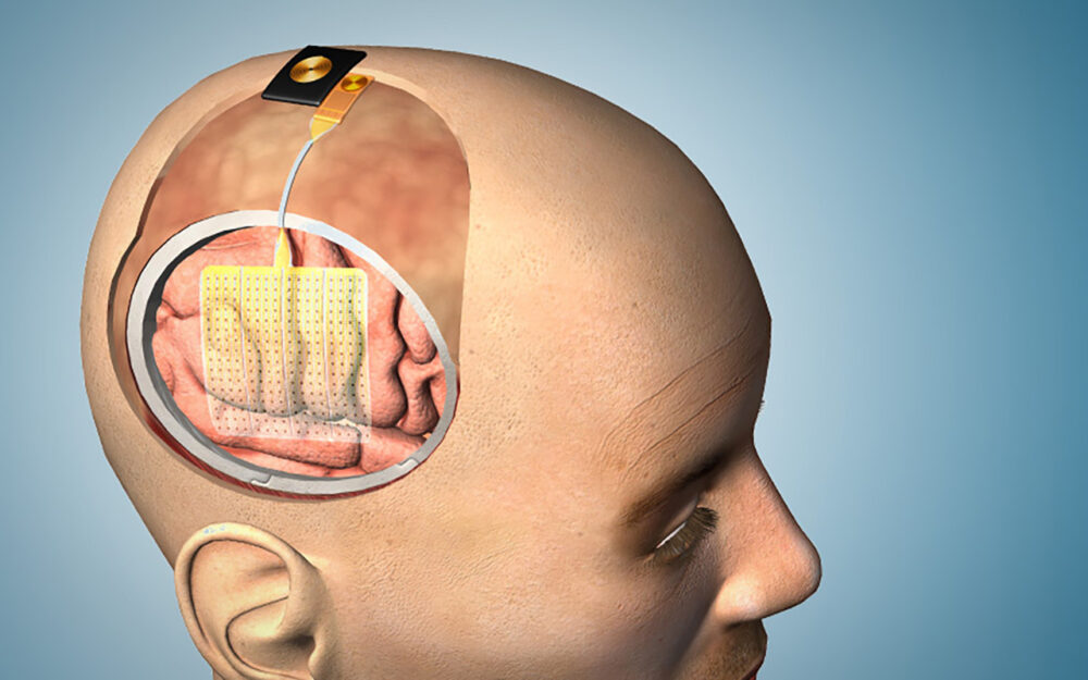 This new brain-mapping device could make neurosurgery safer - Vimarsana News