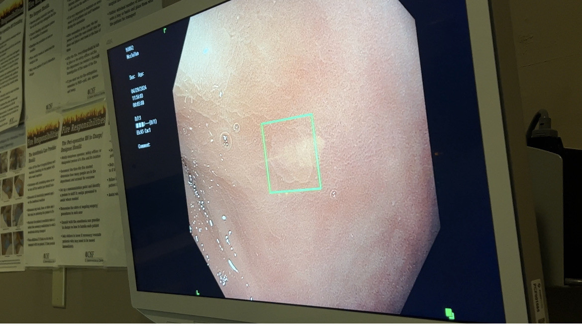 Piloting a smarter colonoscopy - Vimarsana News